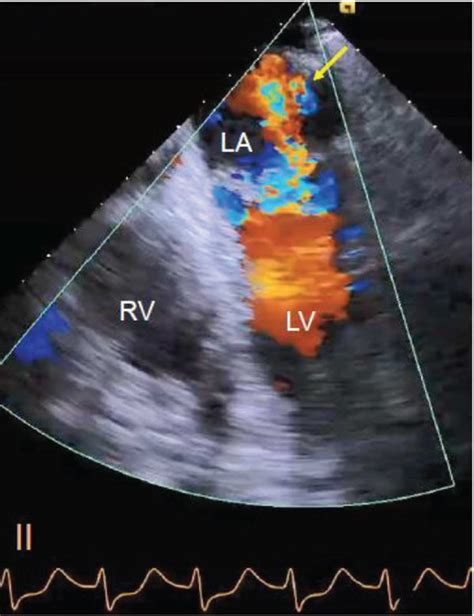 anteroseptal hypokinesis treatment